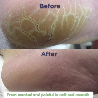 Solevera™ Foot Moisture Masks