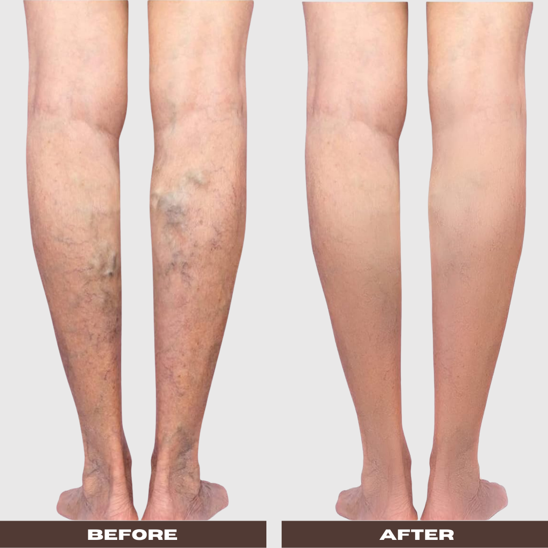 VenaRest™  Relief for Post-Birth Swollen Legs